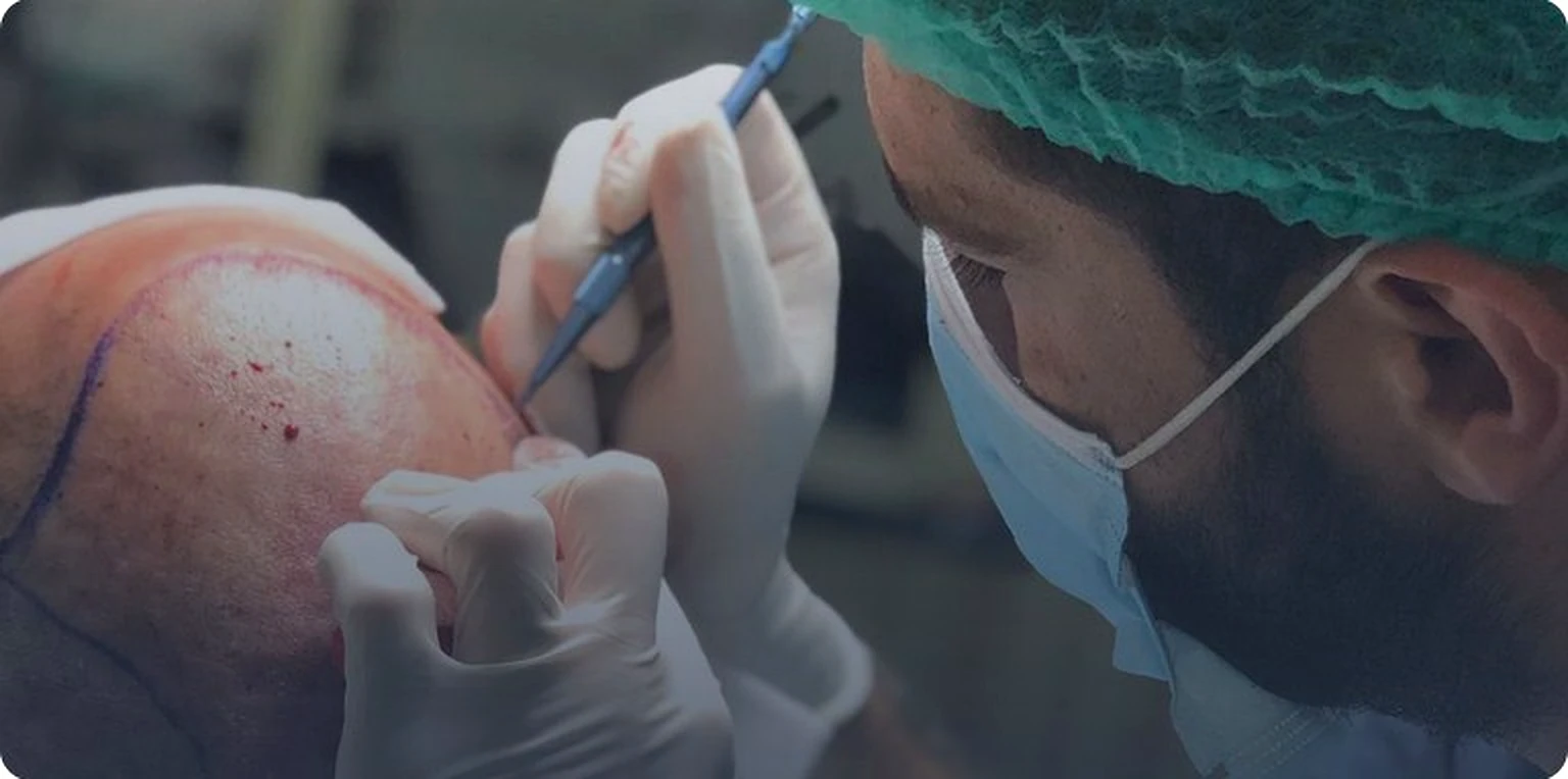 FUE hair transplant procedure — surgeon implanting grafts on scalp at Antalya clinic